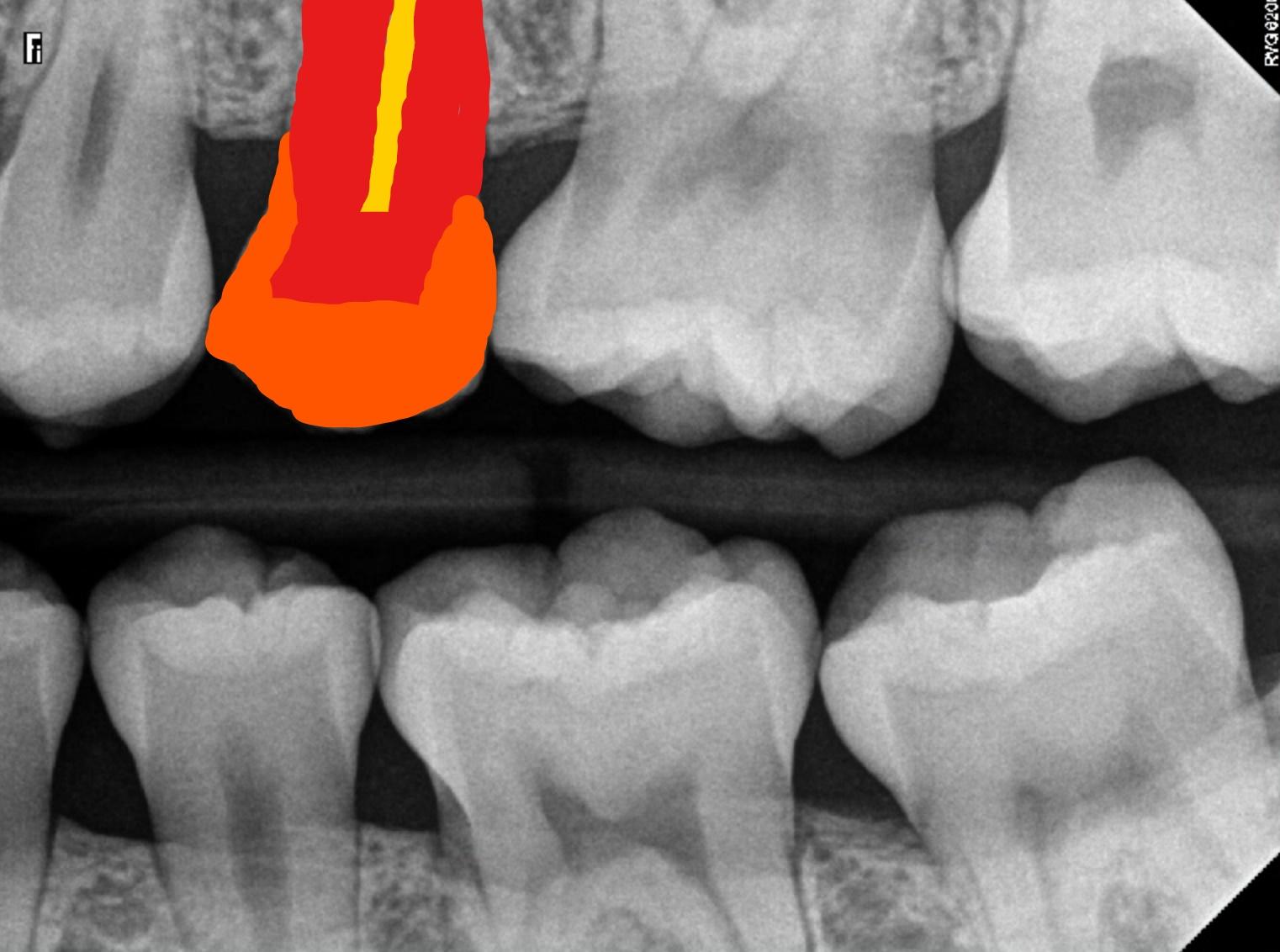 X-Ray of Healthy Teeth with no Cavities