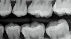 What Does a Cavity Look Like on an X-Ray?