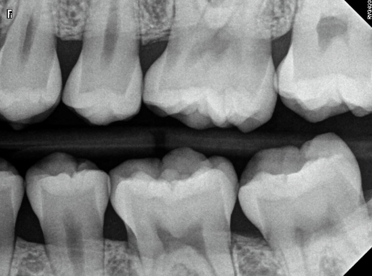 X-Ray of Teeth Under "Observation" Marked Up