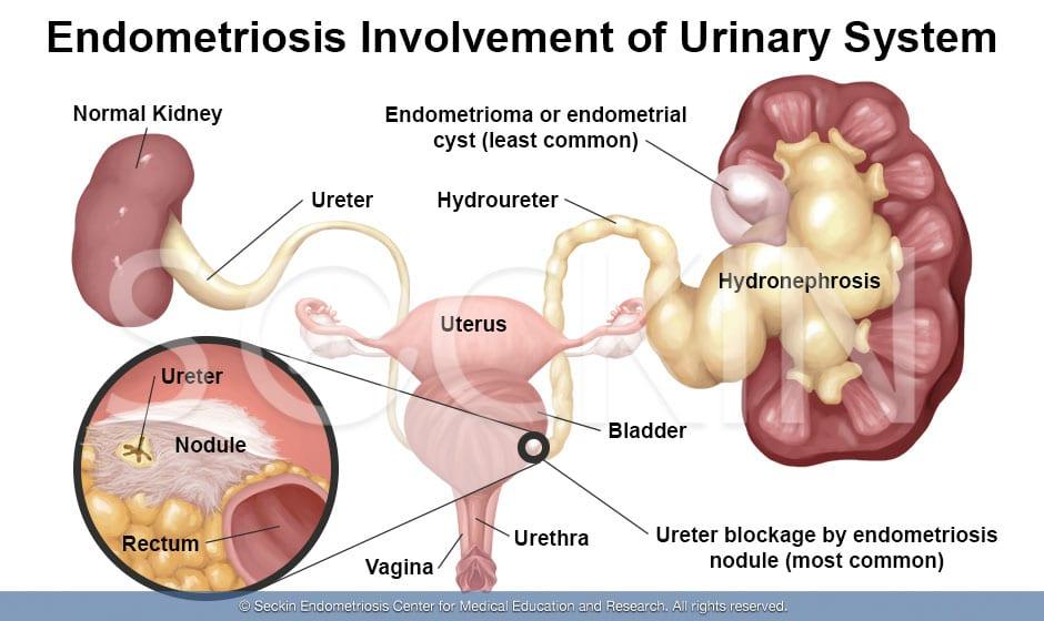 Endometriosis of the kidneys